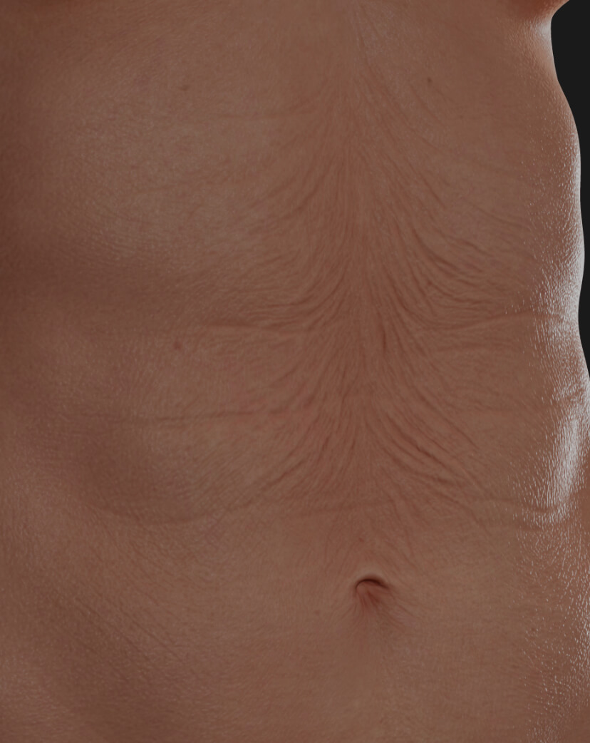 Clinique Chloé female patient's abdomen showing skin laxity to be treated with the Tight Sculpting laser for skin tightening