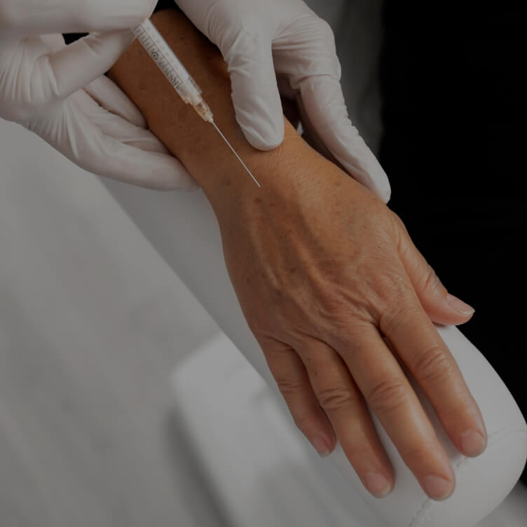 A patient at Clinique Chloé receiving dermal filler injections in their right hand for hand rejuvenation