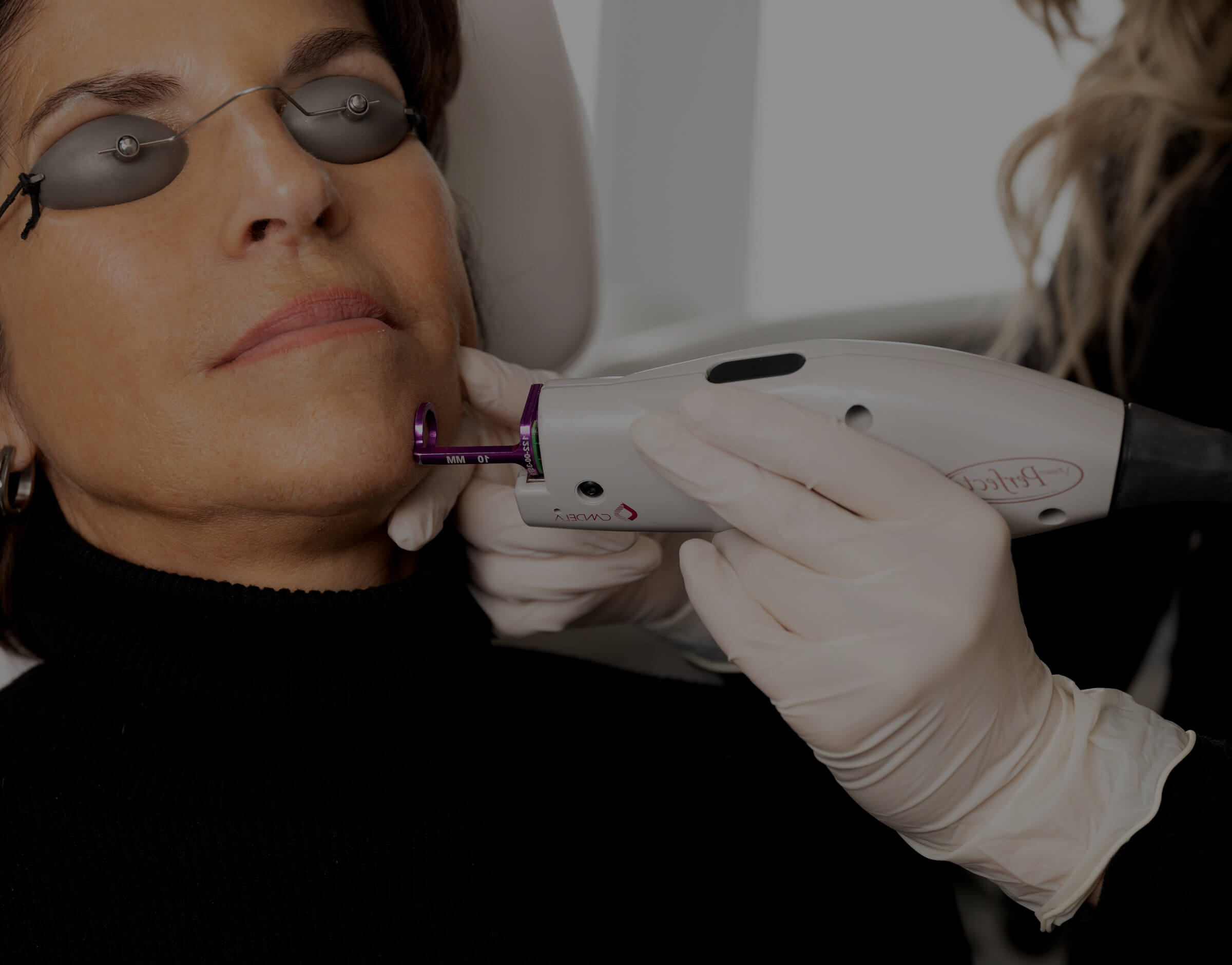 A female patient at Clinique Chloé getting treated on the face with the Vbeam laser