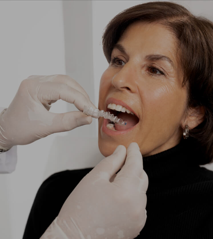 The dentist at Clinique Chloé installing the dental gutters filled with teeth whitening product in a female patient's mouth