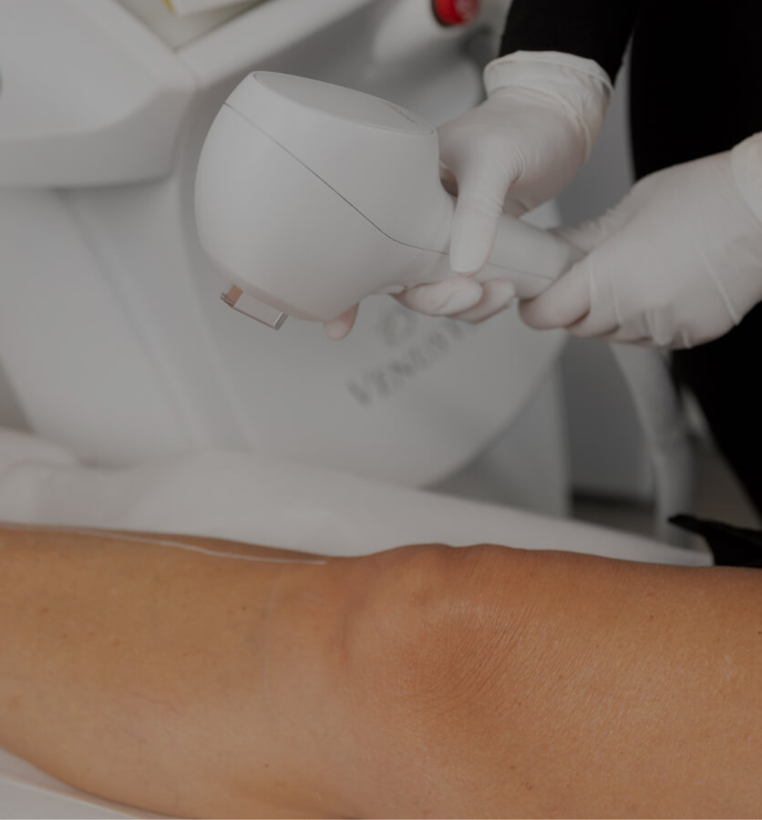 Une technicienne de la Clinique Chloé s'apprêtant à épiler la jambe d'une patiente de façon permanente avec un appareil IPL