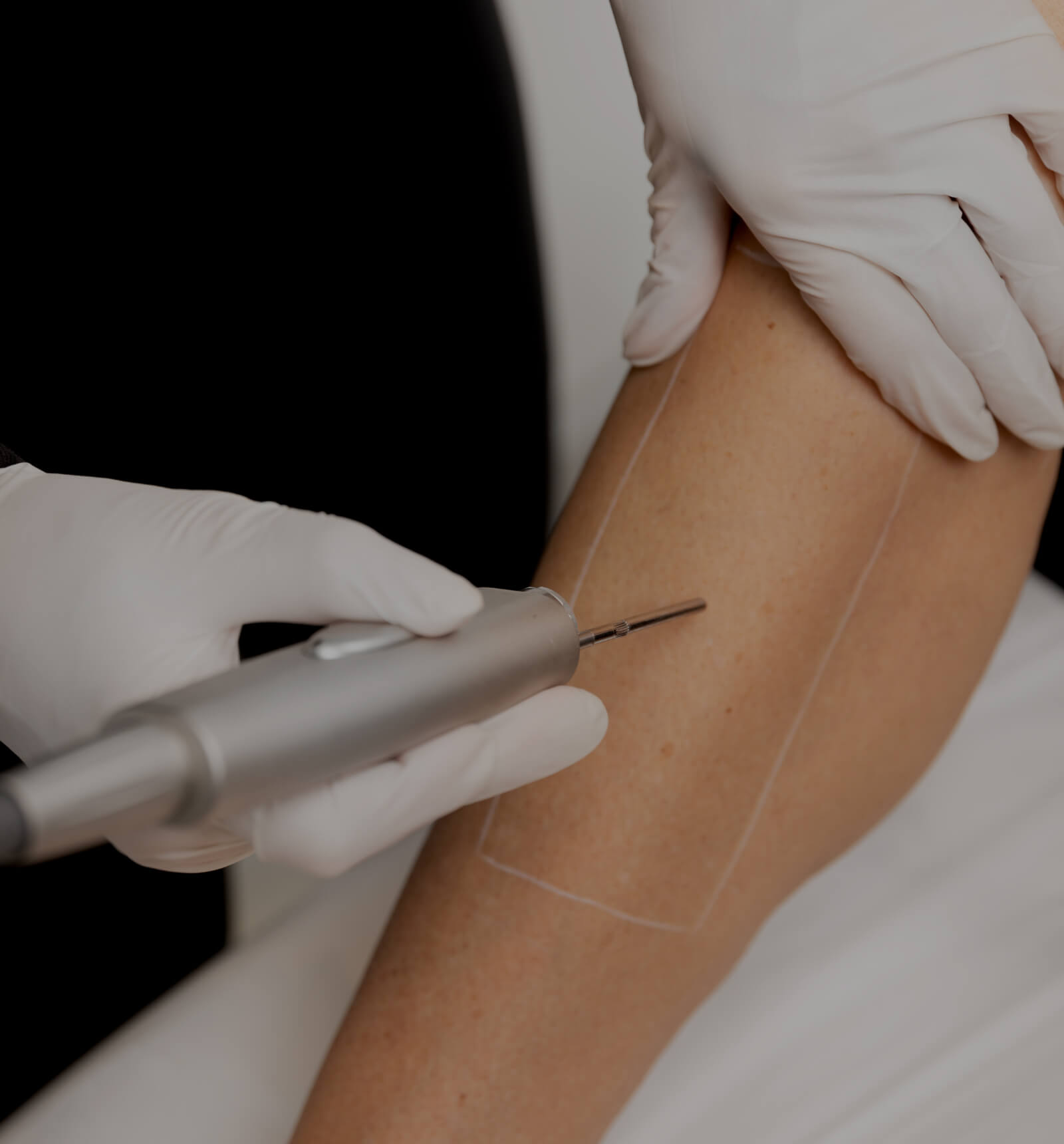 Une technicienne médico-esthétique de la Clinique Chloé utilisant un laser pour l'épilation de la jambe d'une patiente