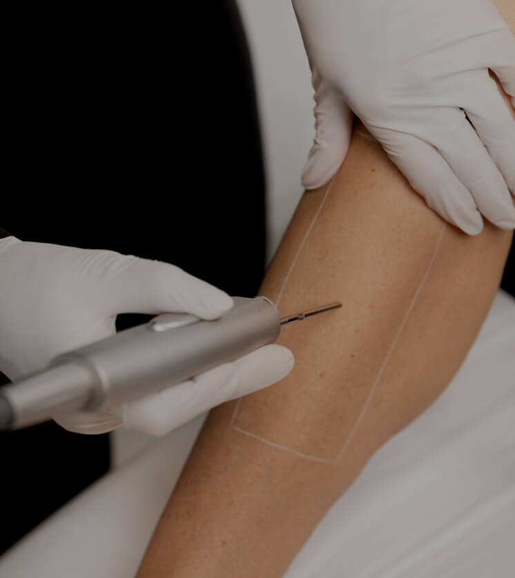 Une technicienne médico-esthétique de la Clinique Chloé utilisant un laser pour l'épilation de la jambe d'une patiente