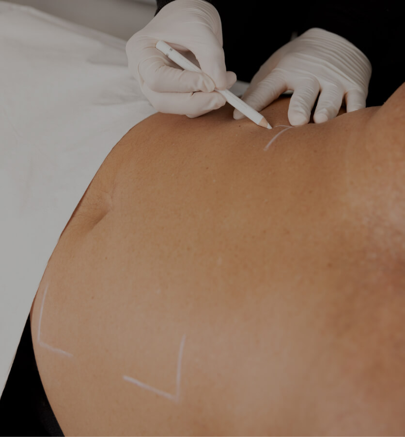 Une technicienne de la Clinique Chloé délimitant avec un crayon blanc la zone à traiter sur l'abdomen d'un patient
