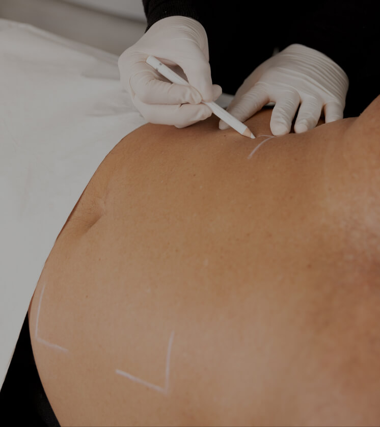 Une technicienne de la Clinique Chloé délimitant avec un crayon blanc la zone à traiter sur l'abdomen d'un patient