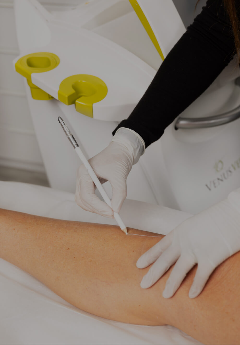 A Clinique Chloé technician delimiting the area to be treated for permanent hair removal with IPL on a woman's leg