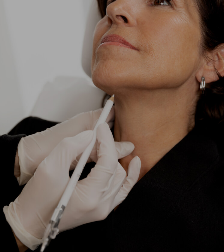 Une technicienne de la Clinique Chloé délimitant la zone à traiter avec le laser TightSculpting dans le cou d'une patiente