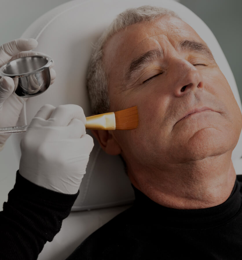 Une technicienne de la Clinique Chloé appliquant un peeling chimique sur le visage d'un patient avec un pinceau