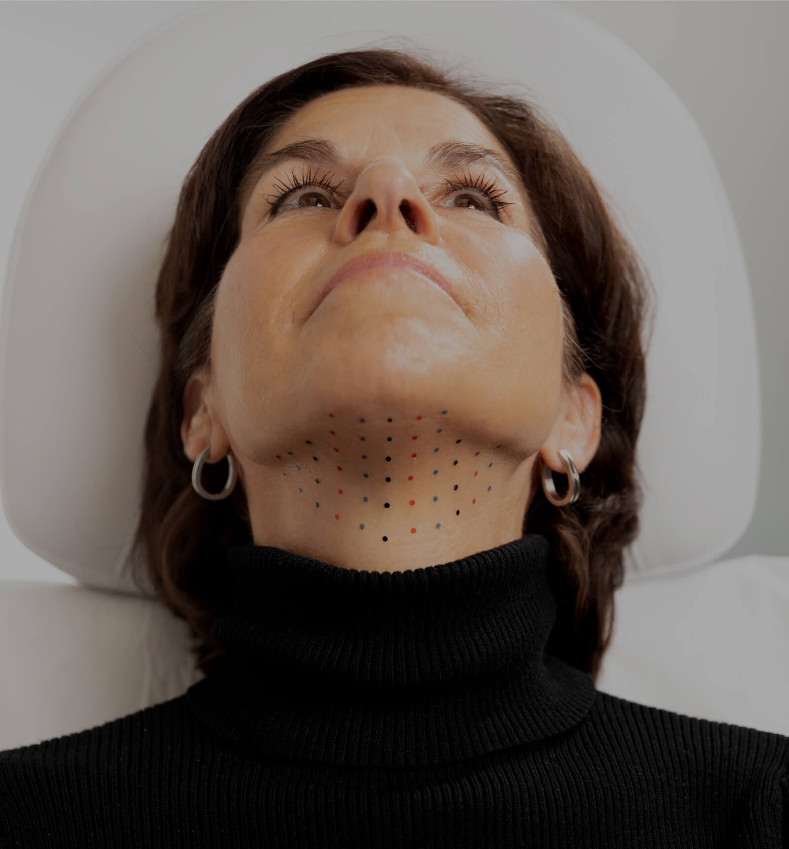 A patient from Clinique Chloé, chin up, showing the grid used on the chin during a Belkyra injection treatment