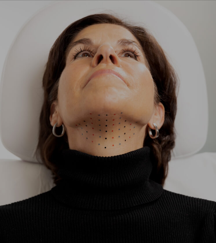 A patient from Clinique Chloé, chin up, showing the grid used on the chin during a Belkyra injection treatment