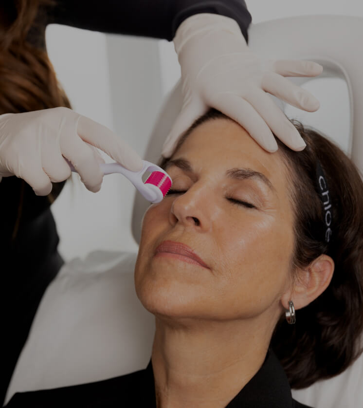 A medico-aesthetic technician from Clinique Chloé performing a microneedling treatment on a female patient