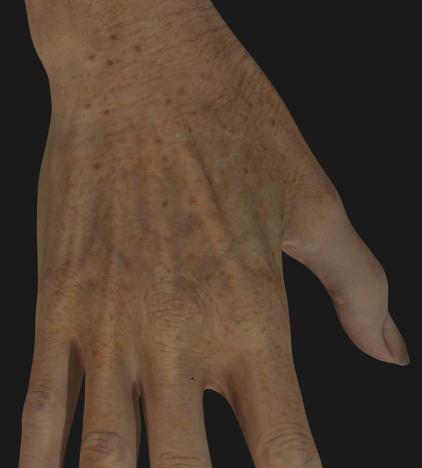 Aging hands of a Clinique Chloé patient to be treated with IPL photorejuvenation