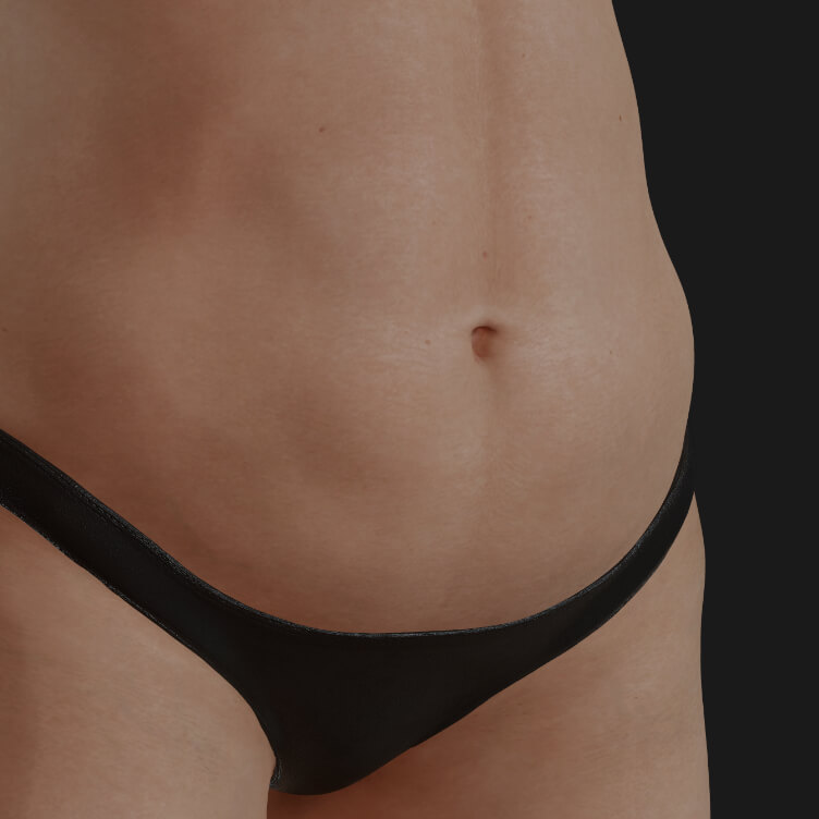 Clinique Chloé female patient with abdominal excess fat to be treated with the Hot Sculpting laser for body contouring