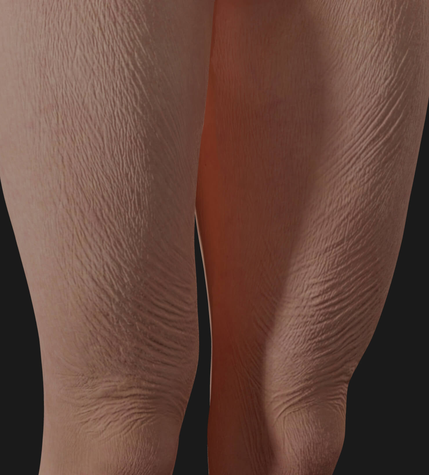 Thighs of a Clinique Chloé female patient showing skin laxity to be treated with Sculptra injections for skin tightening