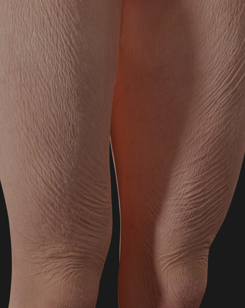 Thighs of a Clinique Chloé female patient showing skin laxity to be treated with Sculptra injections for skin tightening