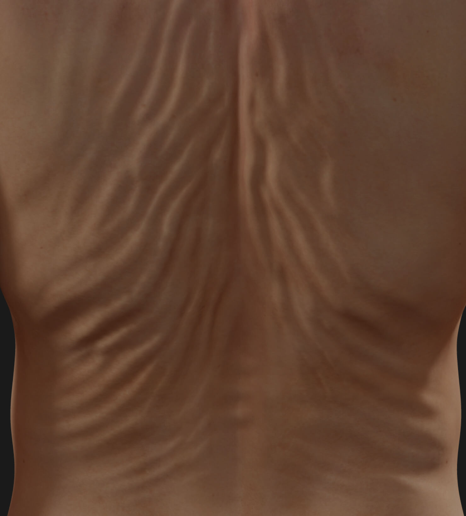 Back of a Clinique Chloé patient showing skin laxity to be treated with Venus Legacy radiofrequency skin tightening