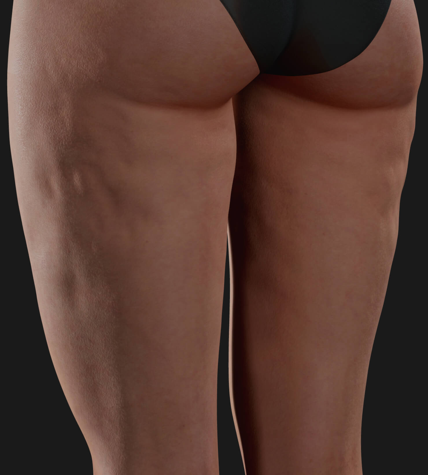 Thighs of a Clinique Chloé female patient showing cellulite, to be treated with Profound RF for cellulite reduction