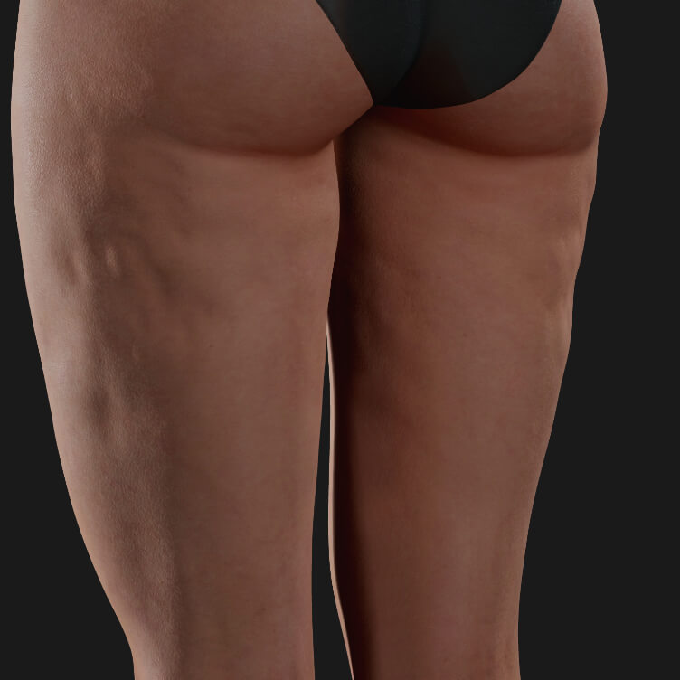 Thighs of a Clinique Chloé female patient showing cellulite, to be treated with Profound RF for cellulite reduction