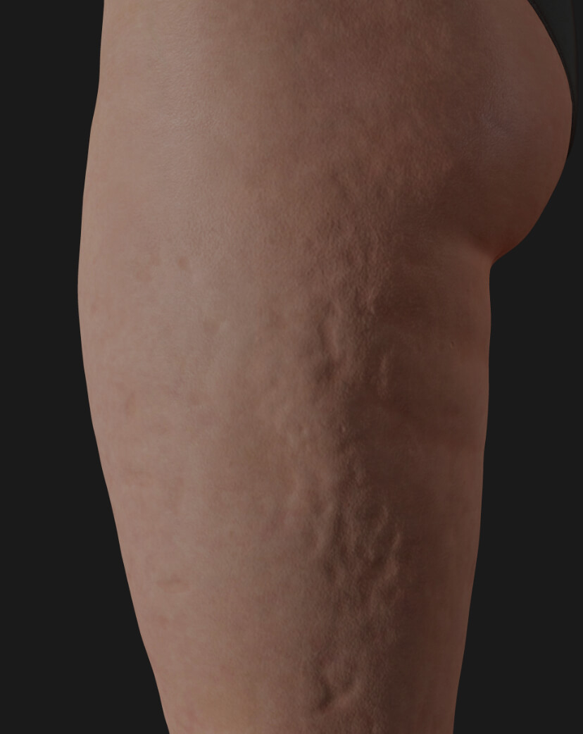 Side thighs of a Clinique Chloé patient showing cellulite, to be treated with Tight Sculpting laser for cellulite reduction