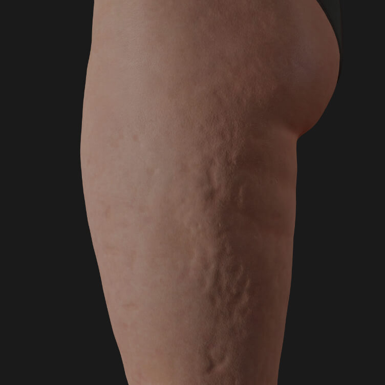 Side thighs of a Clinique Chloé patient showing cellulite, to be treated with Tight Sculpting laser for cellulite reduction