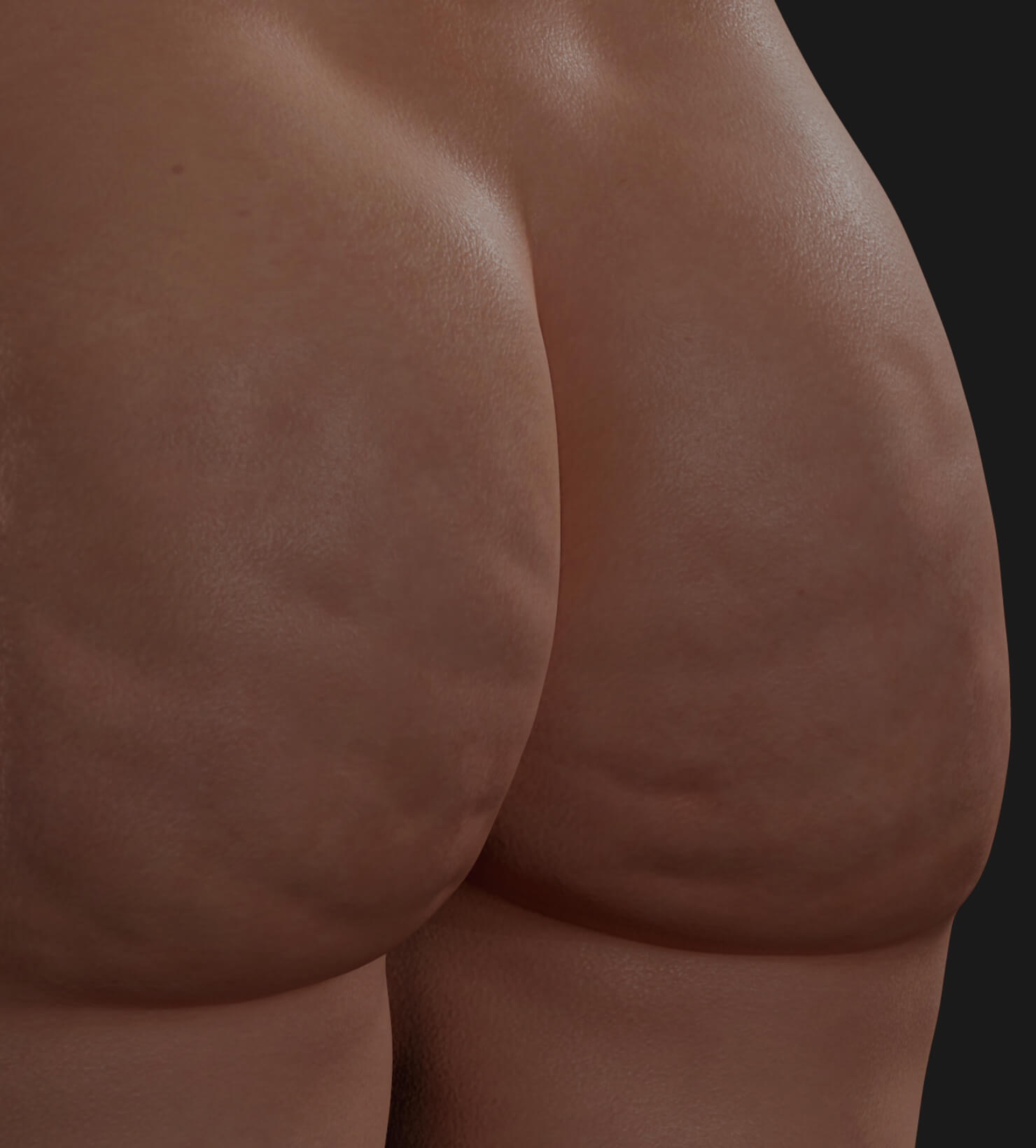 Buttocks of a Clinique Chloé patient showing cellulite, to be treated with Venus Legacy for cellulite reduction