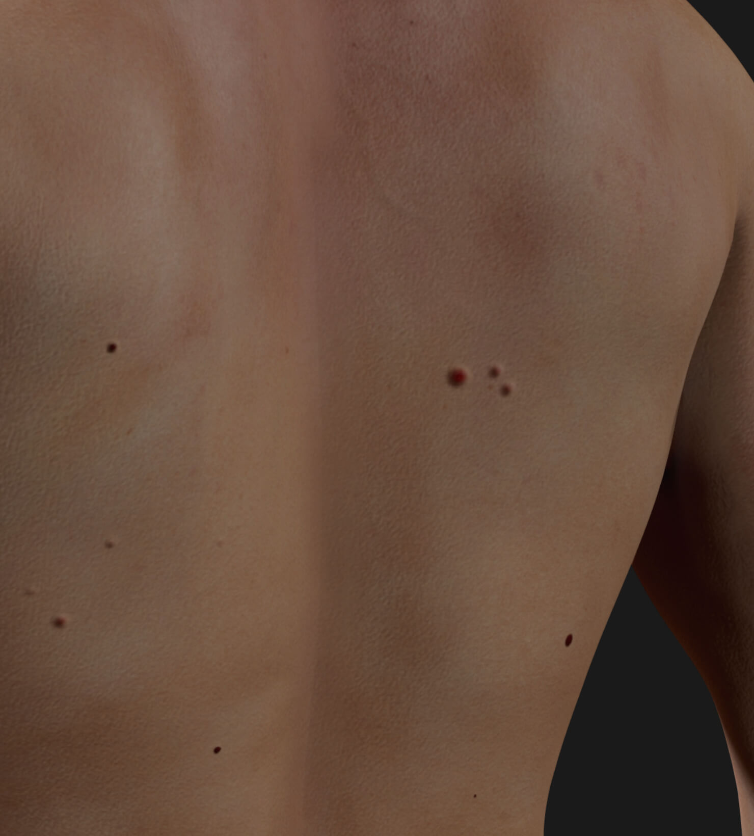Back of a Clinique Chloé male patient showing multiple cherry angiomas to be treated with the Vbeam pulsed dye laser