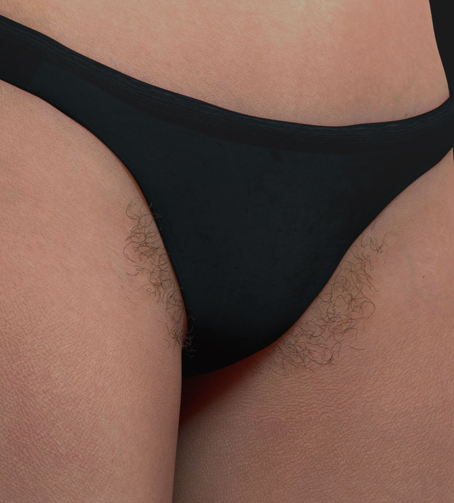 Clinique Chloé patient with unwanted hair to be treated with IPL permanent hair removal
