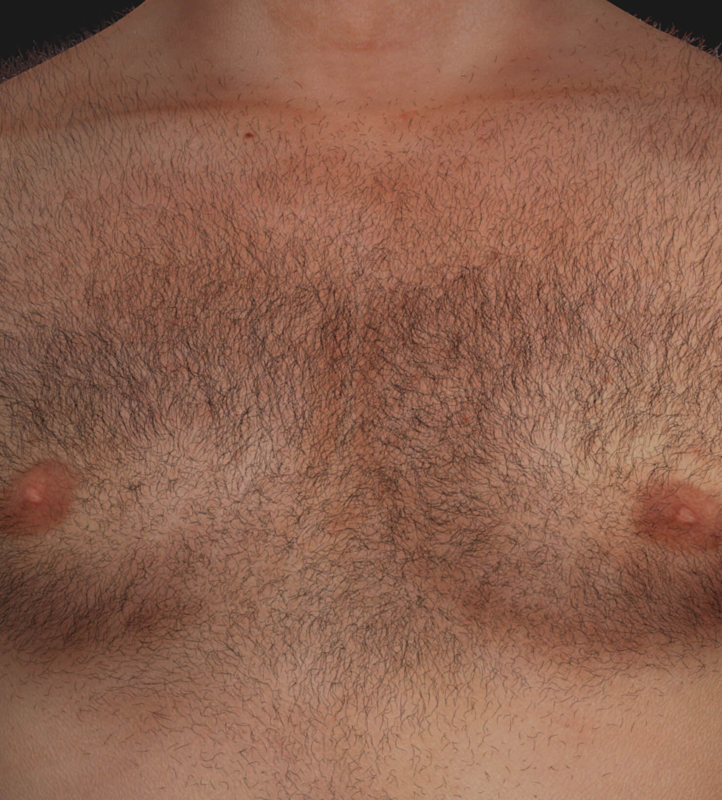 Chest of a Clinique Chloé male patient with unwanted hair to be treated with permanent laser hair removal