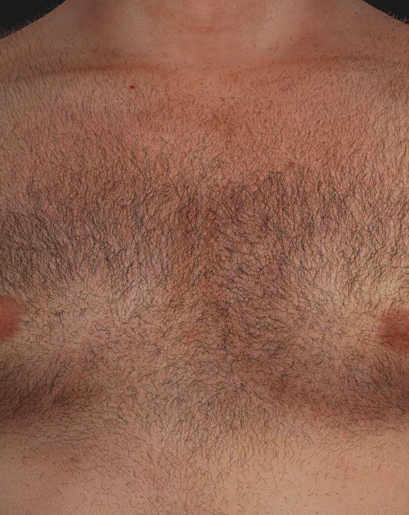 Chest of a Clinique Chloé male patient with unwanted hair to be treated with permanent laser hair removal