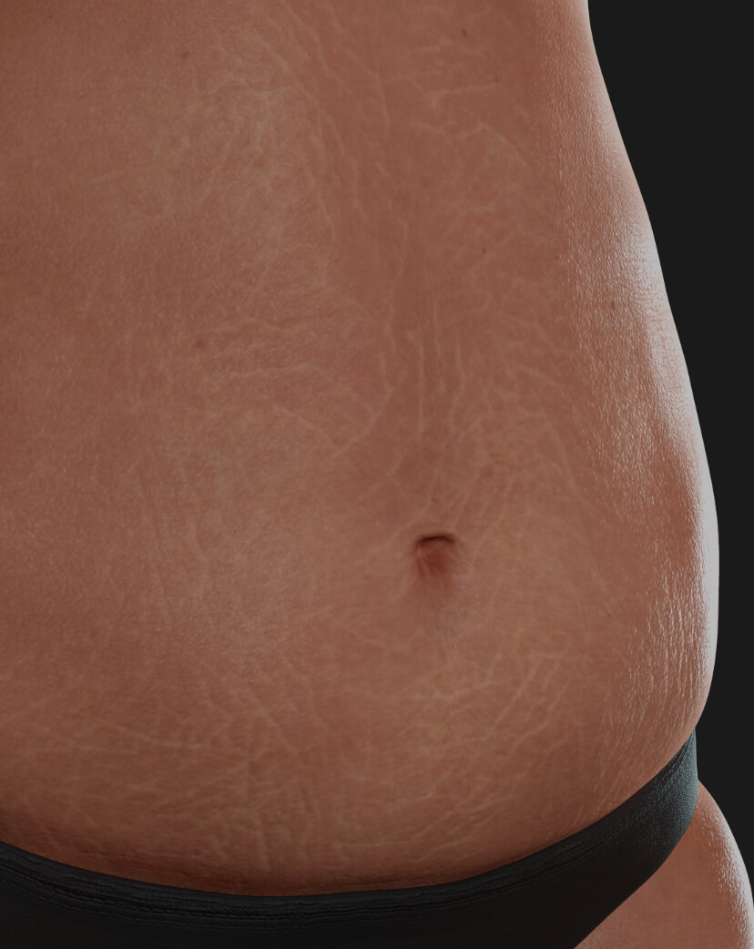 Abdomen of a Clinique Chloé female patient with stretch marks to be treated with Venus Viva fractional radiofrequency