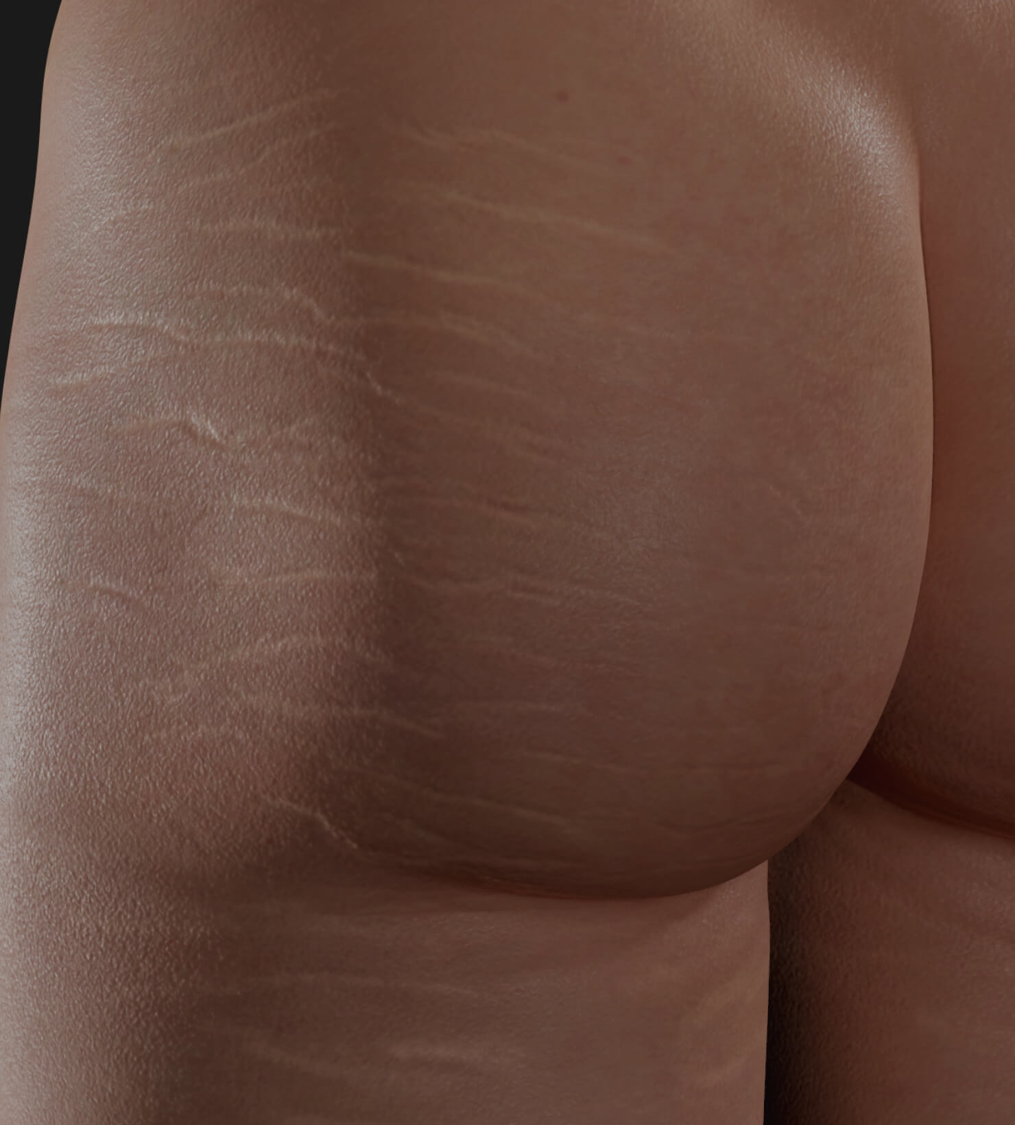 Buttocks of a Clinique Chloé female patient with stretch marks to be treated with platelet-rich plasma, or PRP