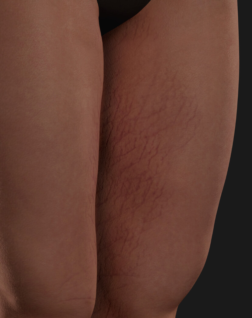 Thighs of a Clinique Chloé female patient with stretch marks to be treated with Venus Viva fractional radiofrequency