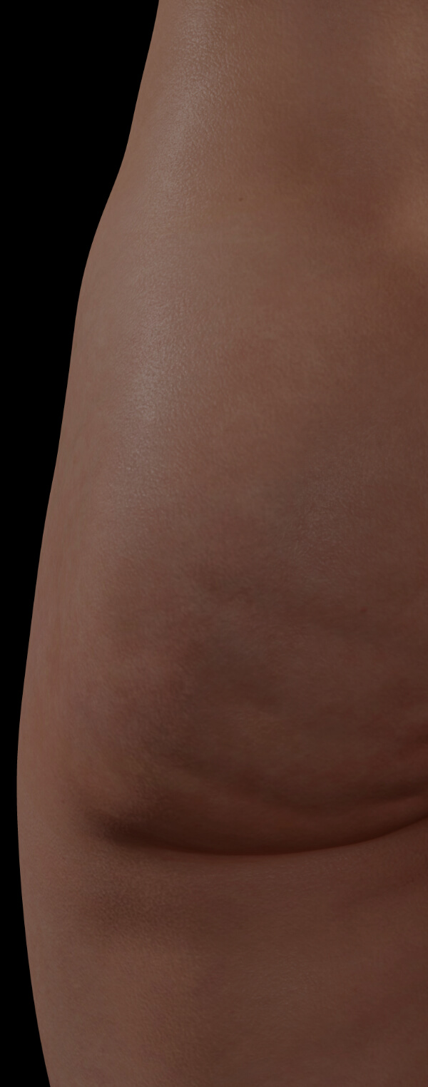 Female patient from Clinique Chloé with cellulite
