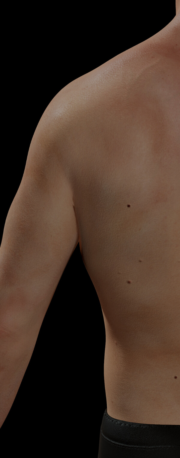 Clinique Chloé patient with cherry angiomas over his body