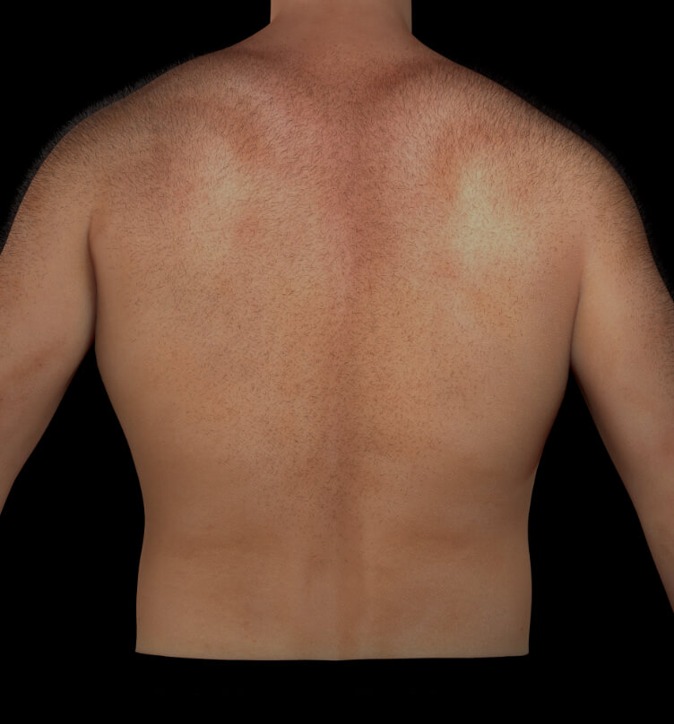 Patient de la Clinique Chloé ayant des poils indésirables dans le dos, nécessitant une épilation permanente