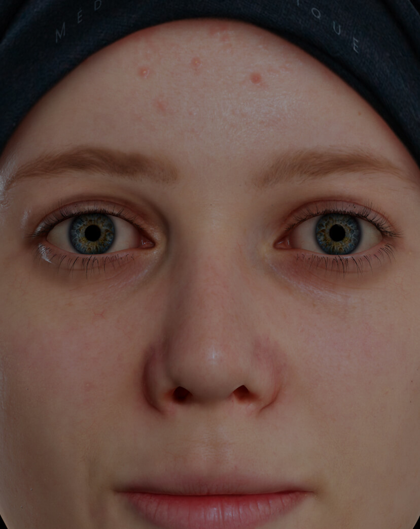 Jeune patiente de la Clinique Chloé souffrant d'acné active sur le visage traitée avec des peelings chimiques