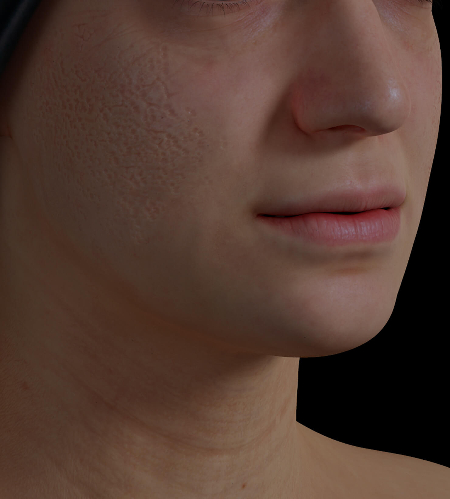 Clinique Chloé female patient with acne scars on the face getting treated with dermal fillers