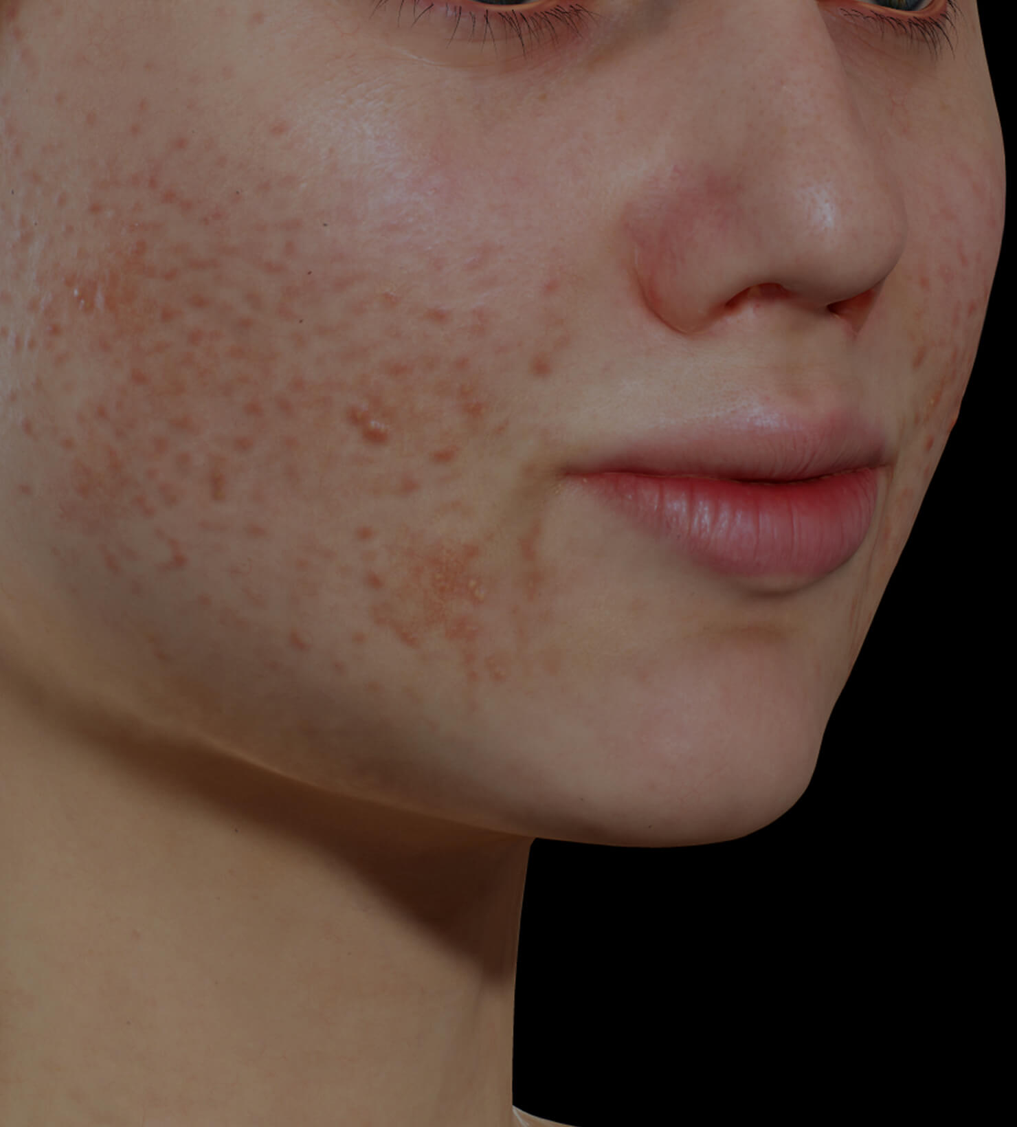 Jeune patiente de la Clinique Chloé souffrant d'acné active sur le visage traitée avec le laser à colorant pulsé Vbeam