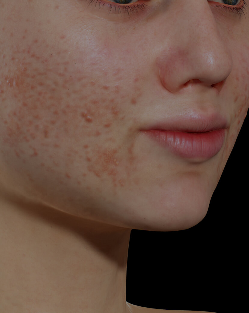 Young Clinique Chloé female patient with active acne on her face getting treated with the Vbeam pulsed dye laser