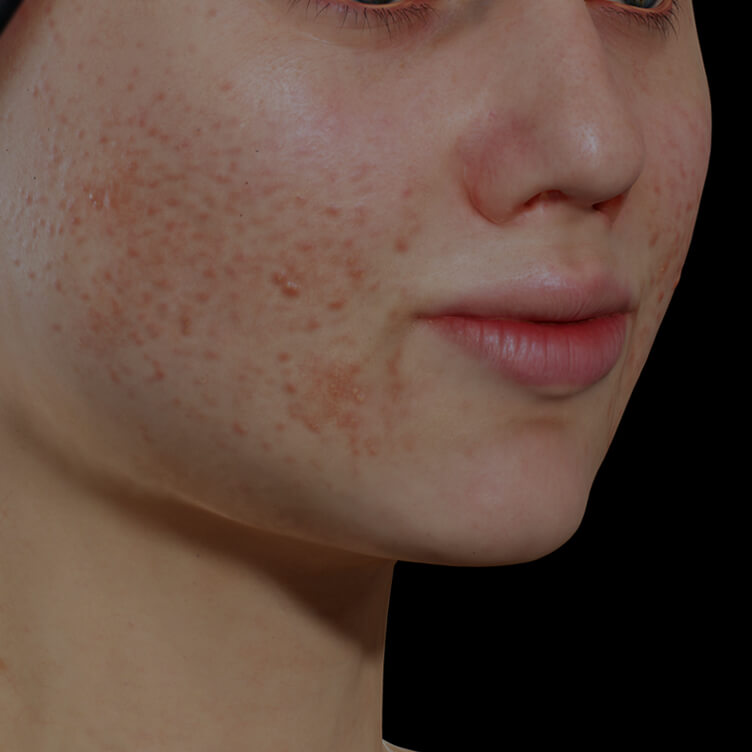Jeune patiente de la Clinique Chloé souffrant d'acné active sur le visage traitée avec le laser à colorant pulsé Vbeam