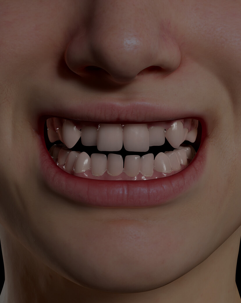 Patient de la Clinique Chloé avec les dents croches s'apprêtant à recevoir des aligneurs invisibles Invisalign