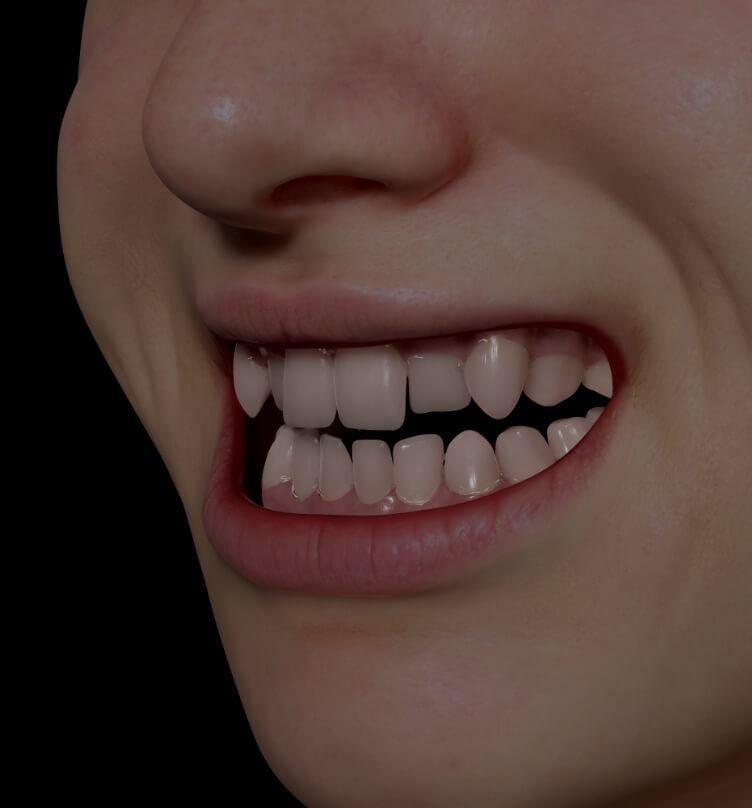 Patient de la Clinique Chloé montrant un sourire avec les dents croches