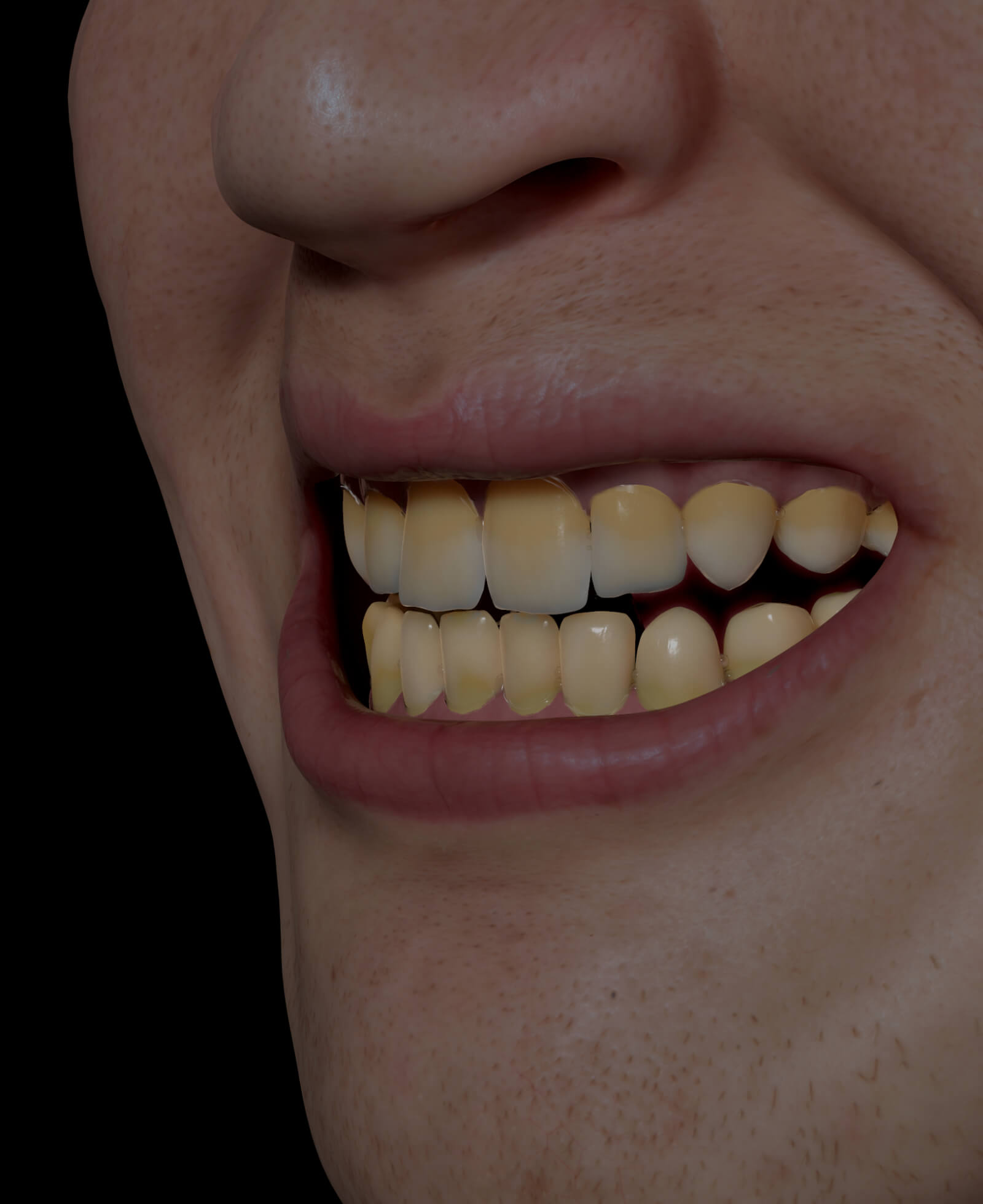 Patient de la Clinique Chloé avec des dents décolorées, jaunes