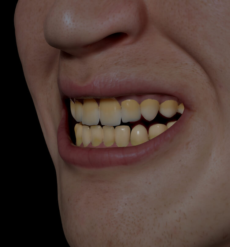 Patient de la Clinique Chloé avec des dents décolorées, jaunes