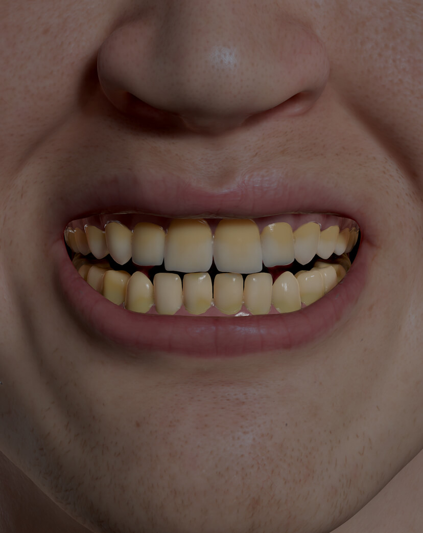 Patient de la Clinique Chloé présentant une décoloration des dents traité pour un blanchiment dentaire professionnel