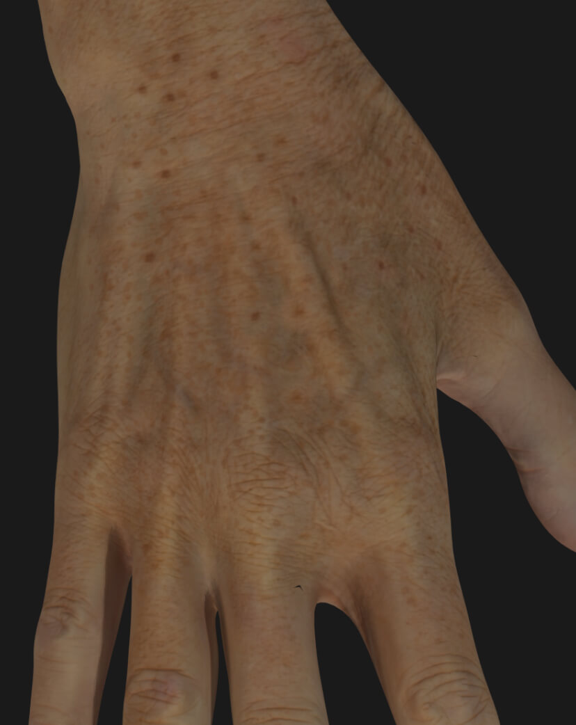 Main d'une patiente de la Clinique Chloé à être traitée avec le photorajeunissement IPL