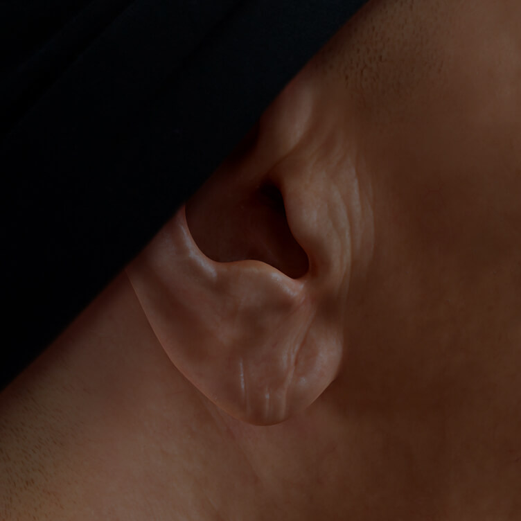 Patiente de la Clinique Chloé avec des lobes d'oreilles relâchés traitée avec des injections d'agents de comblement