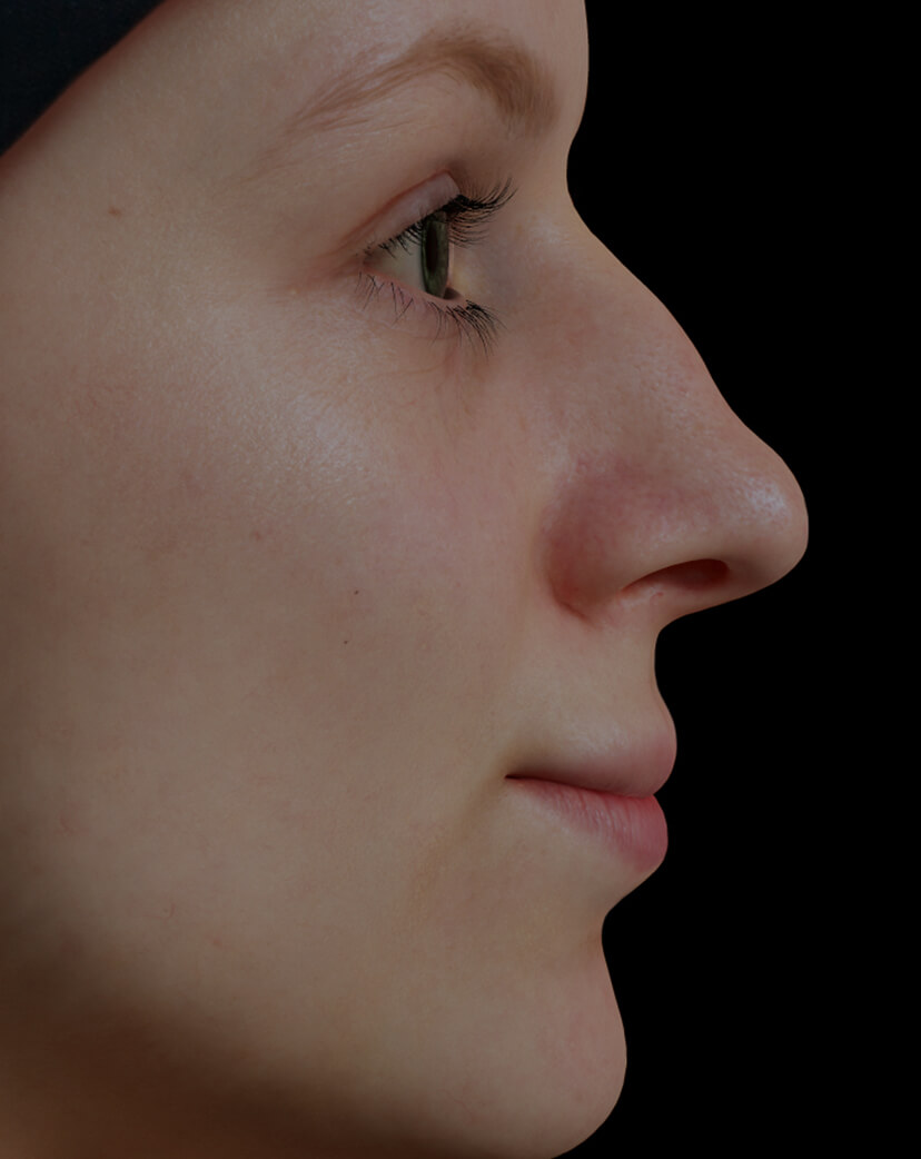 Patiente de la Clinique Chloé avec un nez présentant des bosses traitée avec des injections d'agents de comblement