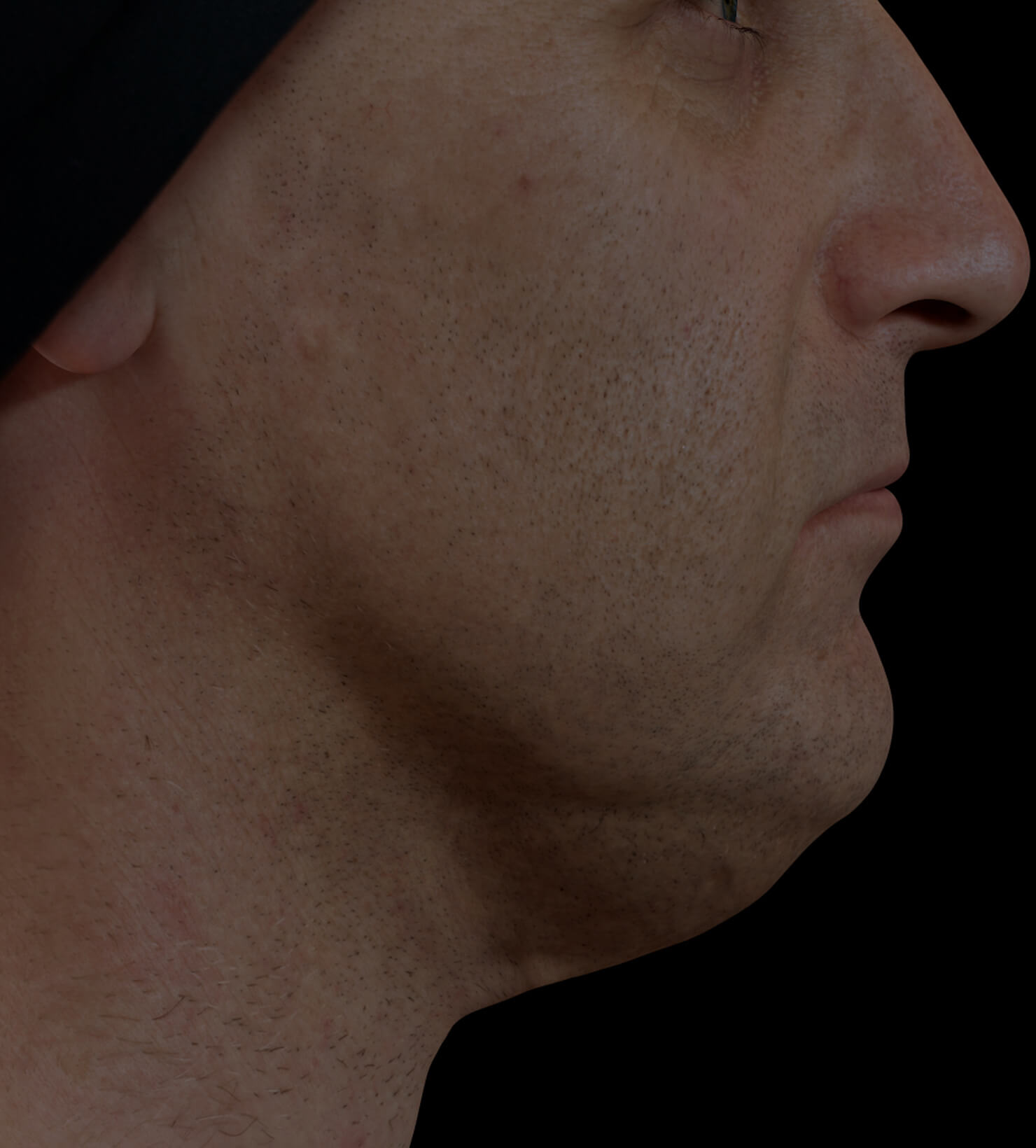 Clinique Chloé male patient with volume under the chin, or double chin, treated with Belkyra injections