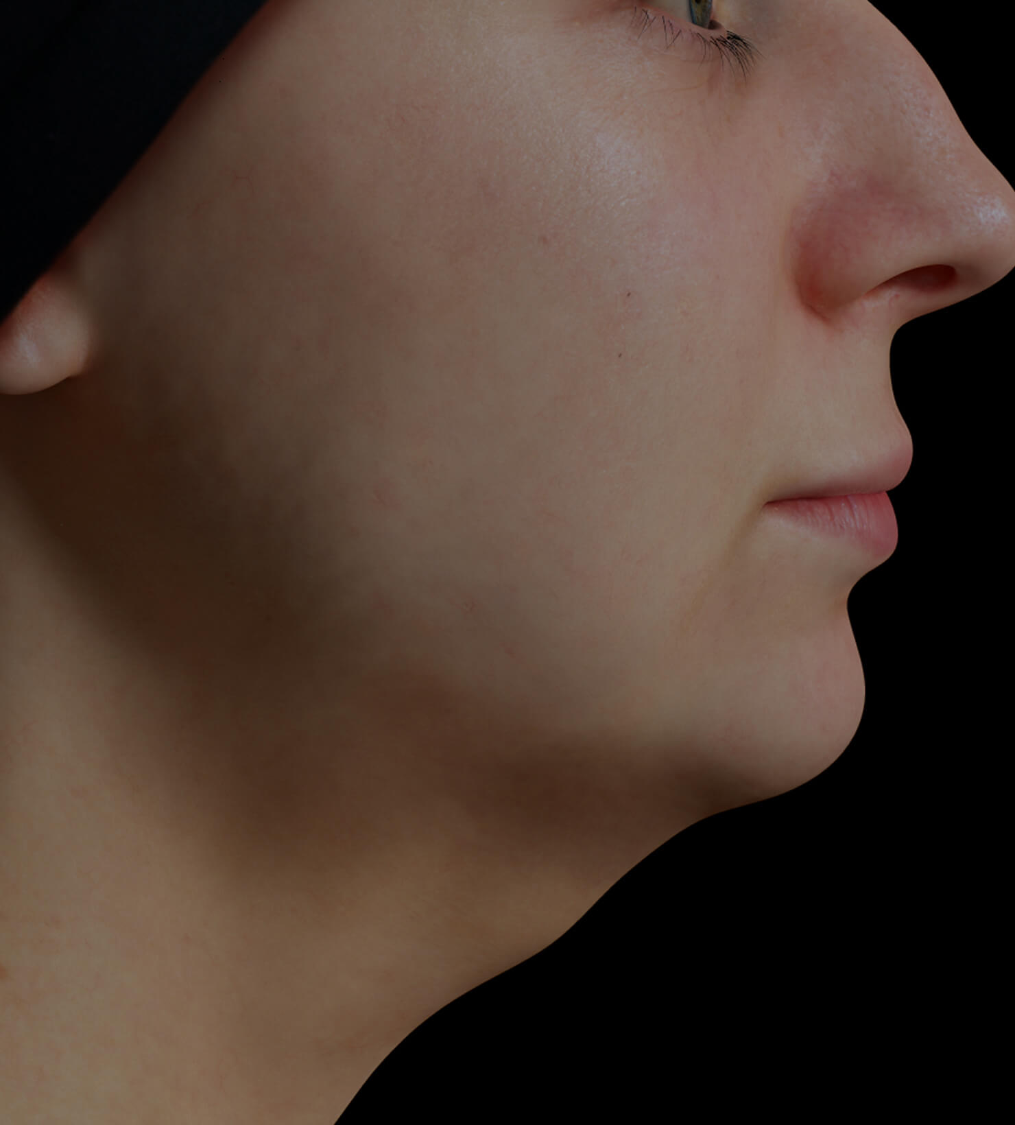 Clinique Chloé female patient with volume under the chin, or double chin, treated with Profound radiofrequency microneedling